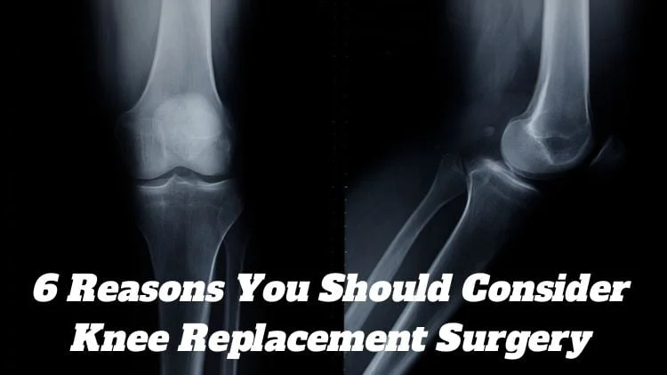 6 Reasons You Should Consider Knee Replacement Surgery